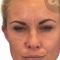 Nichtchirurgische Faltenbehandlung - BOTOX® / DYSPORT®