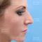 Operácia nosa (Rhinoplastika)