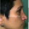 Operácia nosa (Rhinoplastika)