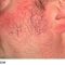 Eliminare capillari e teleangectasie con laser