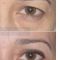 Blépharoplastie