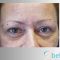 Operácia očných viečok (Blepharoplastika)