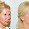 Facelift, SMAS facelifting