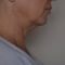 Exilis (Neinvazivní lifting)