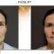 Facelift