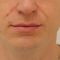 Kwas hialuronowy: Saypha, Restylane, Juvederm, Stylage