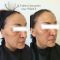Lifting non chirurgical (Liquid facelift)