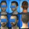 Otoplastie (Chirurgie esthétique des oreilles)