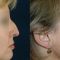 Rhinoplasty (Nose Job)