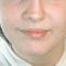 Rhinoplasty (Nose Job)