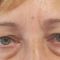 Operácia očných viečok (Blepharoplastika)
