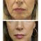 Facelift - 3D kanylové nitě