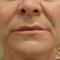Sculptra