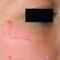Laser Scar Treatment
