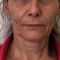 Lifting du cou par fils tenseurs