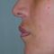 Ingrandimento labbra con grasso (lipofilling)