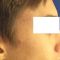 Acne laser, Cicatrici da acne laser