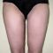 Liposuction
