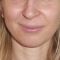 Operácia nosa (Rhinoplastika)