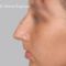 Plastika nosu (Rhinoplastika)