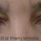 Blépharoplastie inférieure