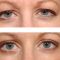 Operácia očných viečok (Blepharoplastika)
