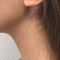 Génioplastie - Chirurgie esthétique du menton