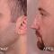 Rhinoplastie