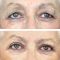 Operácia očných viečok (Blepharoplastika)