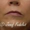 Lipofilling (Fettinjektion)