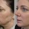 Liquid facelift