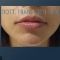 Filler antirughe a base di acido ialuronico