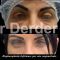 Blépharoplastie inférieure