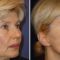 Facelift