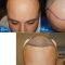 Trapianto capelli