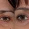 Operácia obočia (Brow lift)