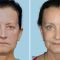 Facelift (operace obličeje), SMAS lifting