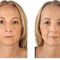 Restylane®