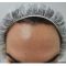 Botulinum toxin - Wrinkle Removal