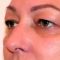 Eyelid surgery (Blepharoplasty)