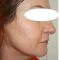 Facelift (operace obličeje), SMAS lifting