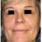 Injections d