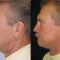 Facelift (operace obličeje), SMAS lifting