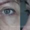 Operácia očných viečok (Blepharoplastika)