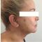 Lifting du visage