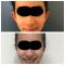 Operazione orecchie (Otoplastica)