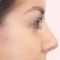 Operácia nosa (Rhinoplastika)
