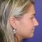 Plastika nosu (Rhinoplastika)