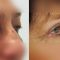 Eyelid surgery (Blepharoplasty)
