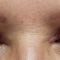 Laserová blefaroplastika